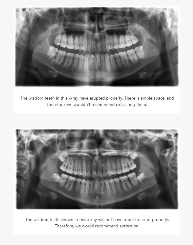 wisdom teeth before and after